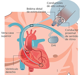 defi implantation
